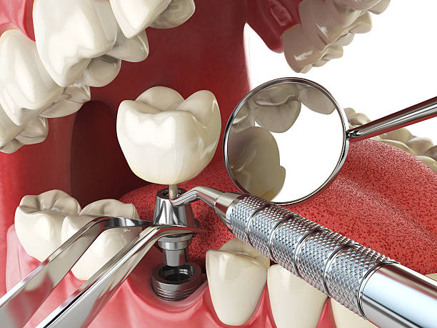 Best Emergency Wisdom Tooth Extraction in Morton, MS